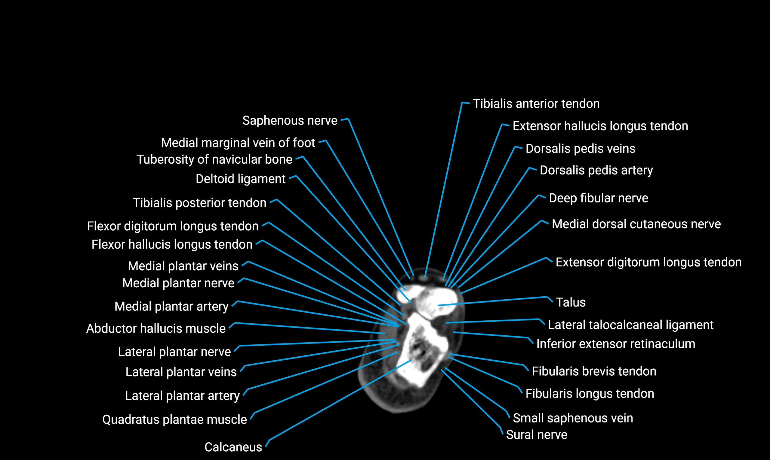 CT lower limb axial cross sectional anatomy labelled image 173 (2).webp